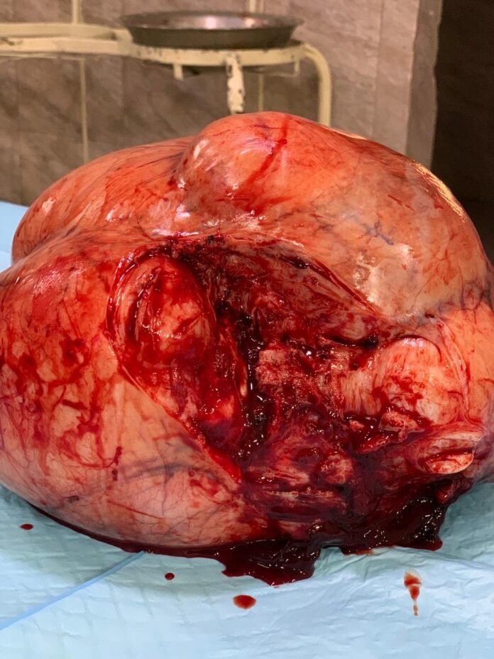 لیاری جنرل اسپتال میں خاتون کے پیٹ سے 15 کلو وزنی رسولی کامیابی سے نکال لی گئی